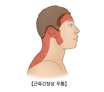 근육 긴장성 두통